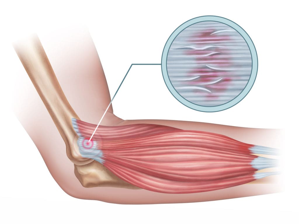 tendinopathie